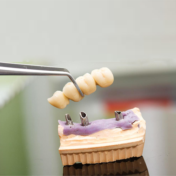 Implant bridge
