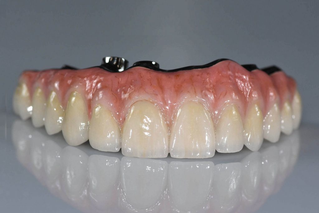 Implant-Assisted-Hybrid-Restoration-1024x682.jpg