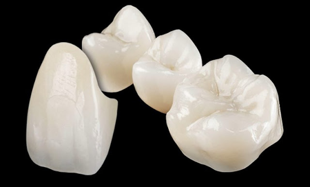 full zirconia crown