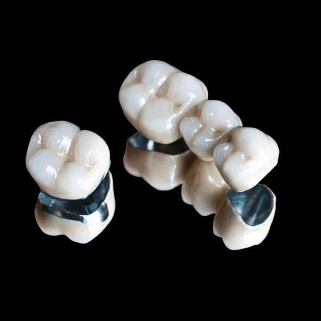 Introduction to Dental Bridges and Crown Procedures